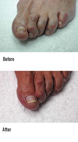 Laser Treatment for Onychomycosis (Nail Fungus)