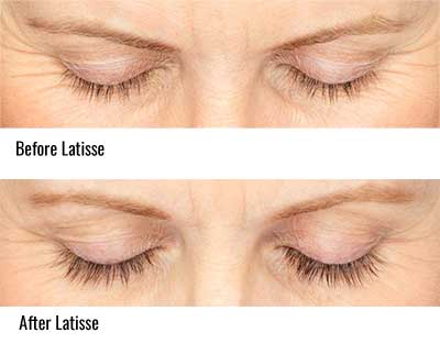 Latisse - Before and After